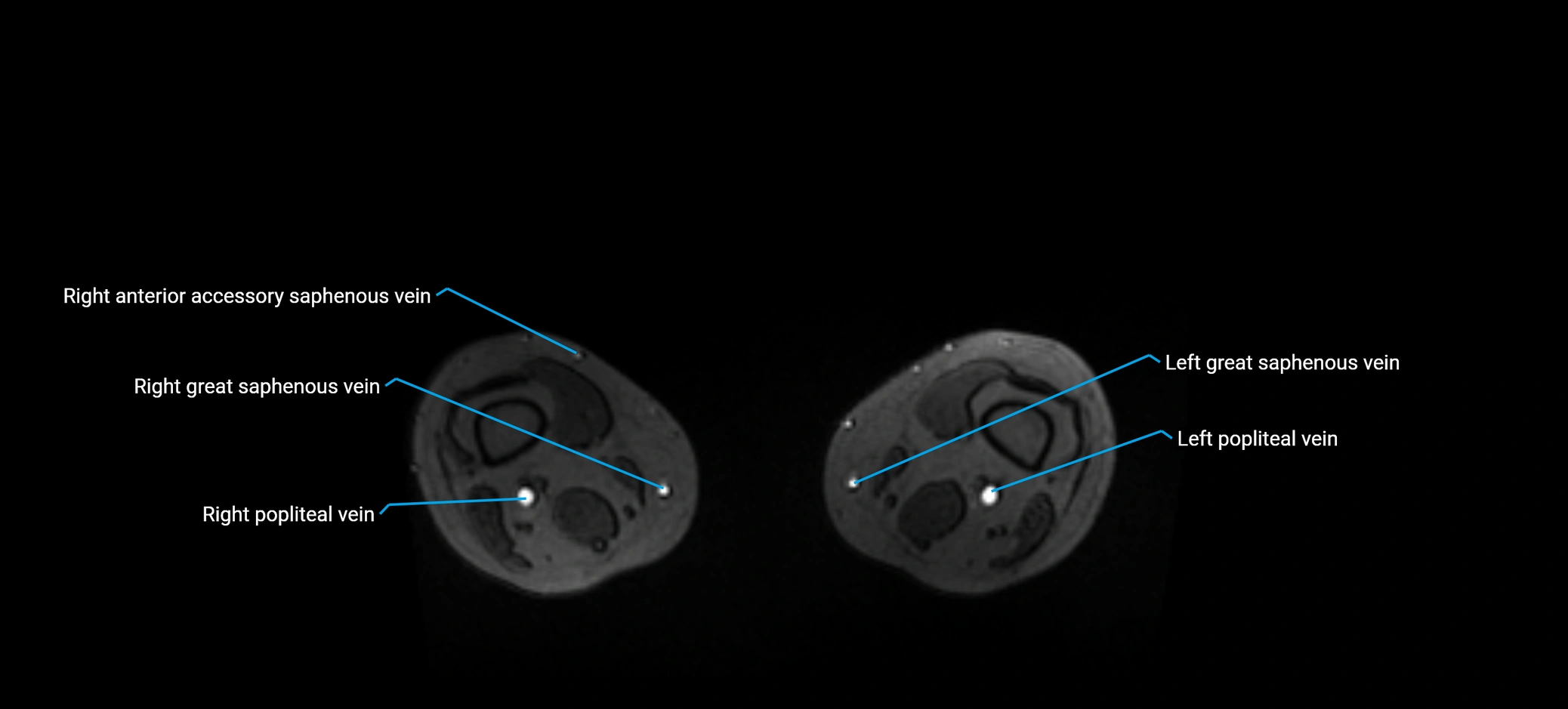 MRV abdomen pelvis & lower limb axial cross sectional anatomy labelled MRI image 341.webp